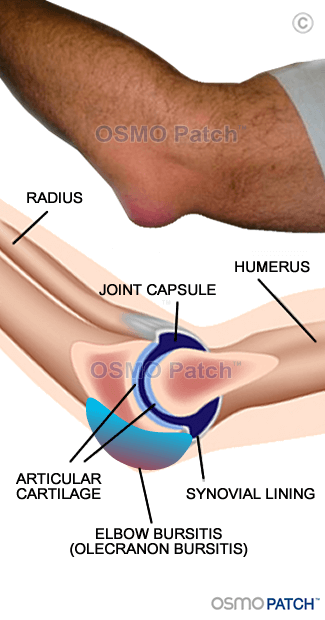 Elbow Bursitis - OSMO Patch - AU