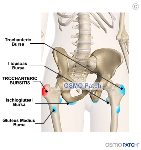 Hip Bursitis - OSMO Patch - AU